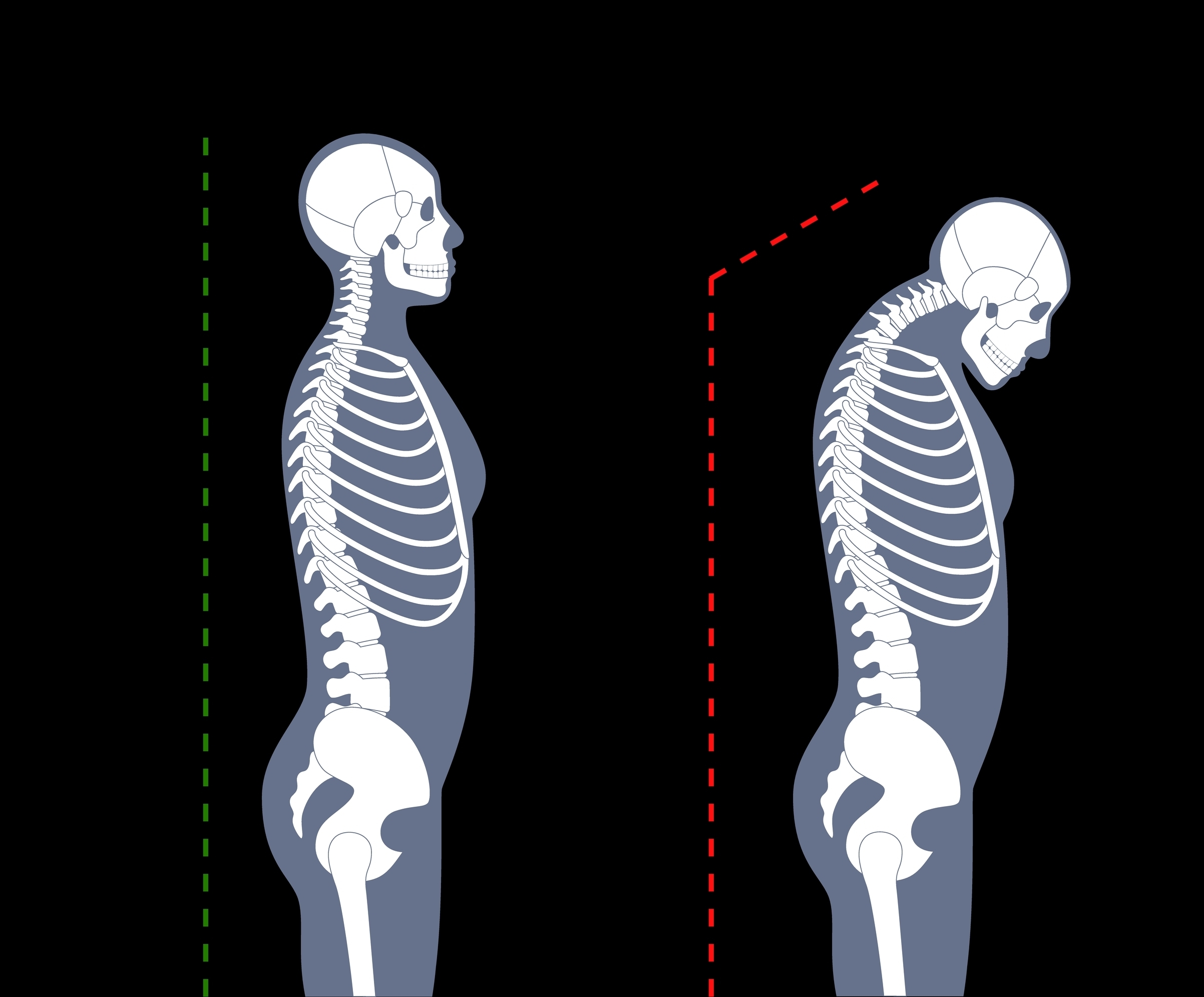 neck hump, chiropractor, spinal